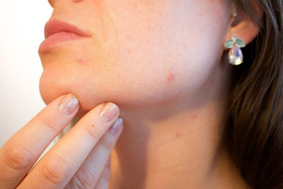 Cystic Acne: Do You Have It? How Can You Get Rid Of It Safely?