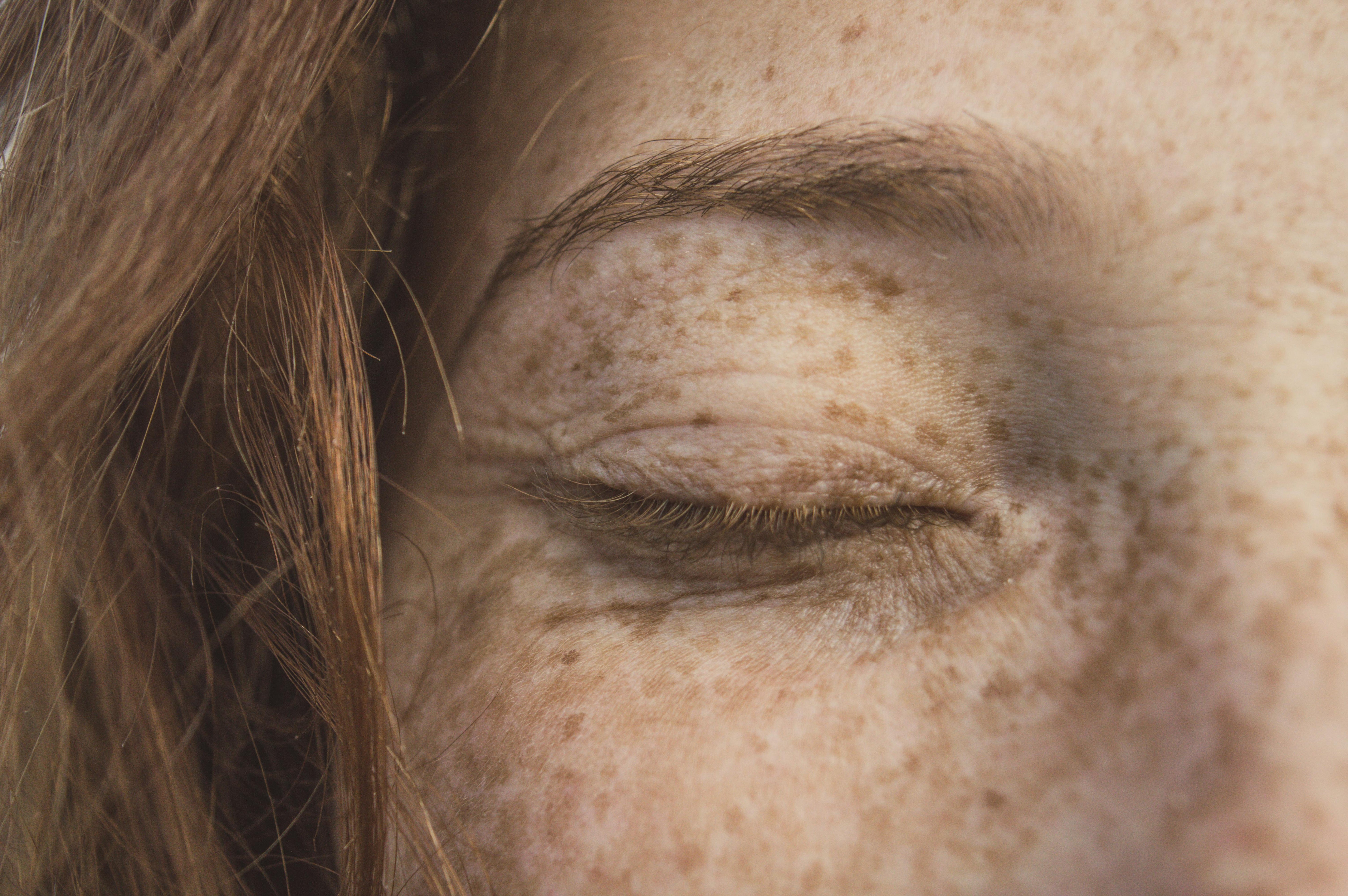 What Causes Freckles? The Complete Guide To Freckles