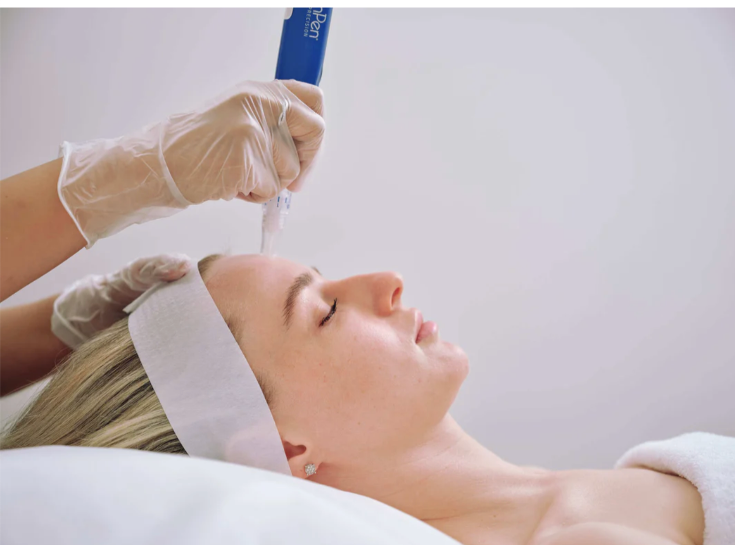 What is Skin Needling? Your Questions Explained.