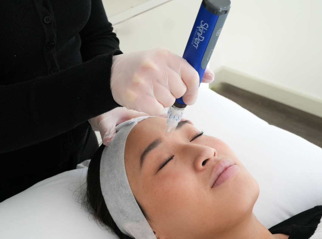 Say Goodbye to Dark Circles with Mesoneedling