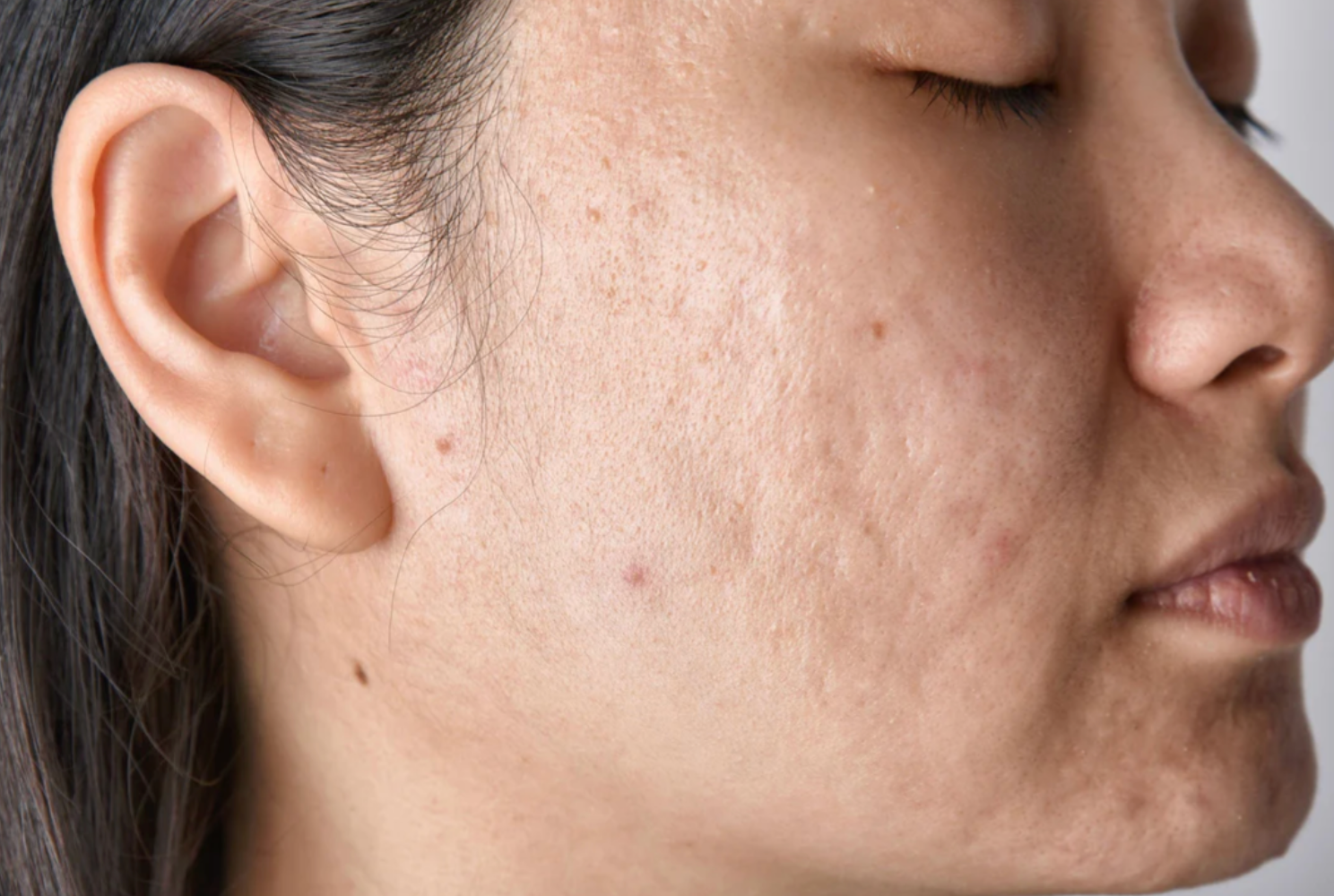 Skin Needling and Acne Scars