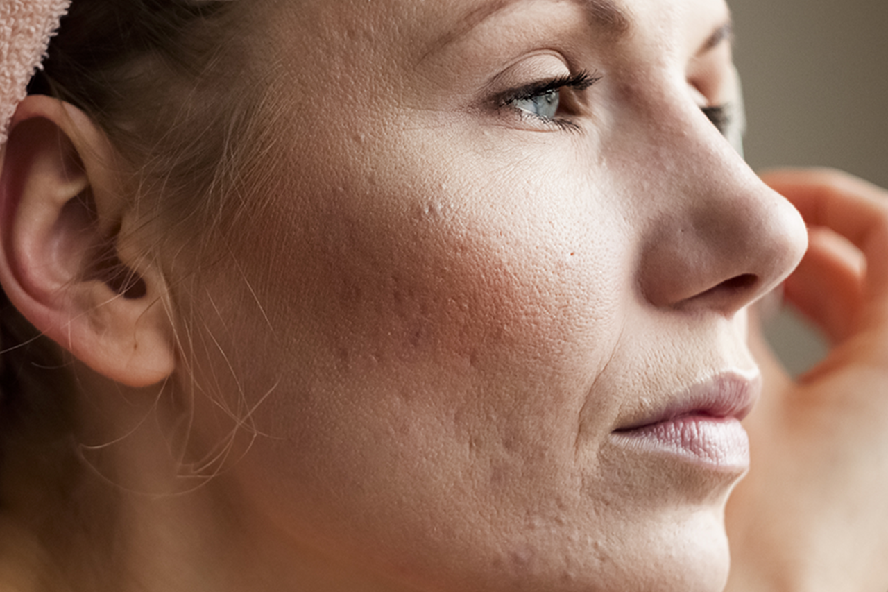 Skin Needling and Acne Scars
