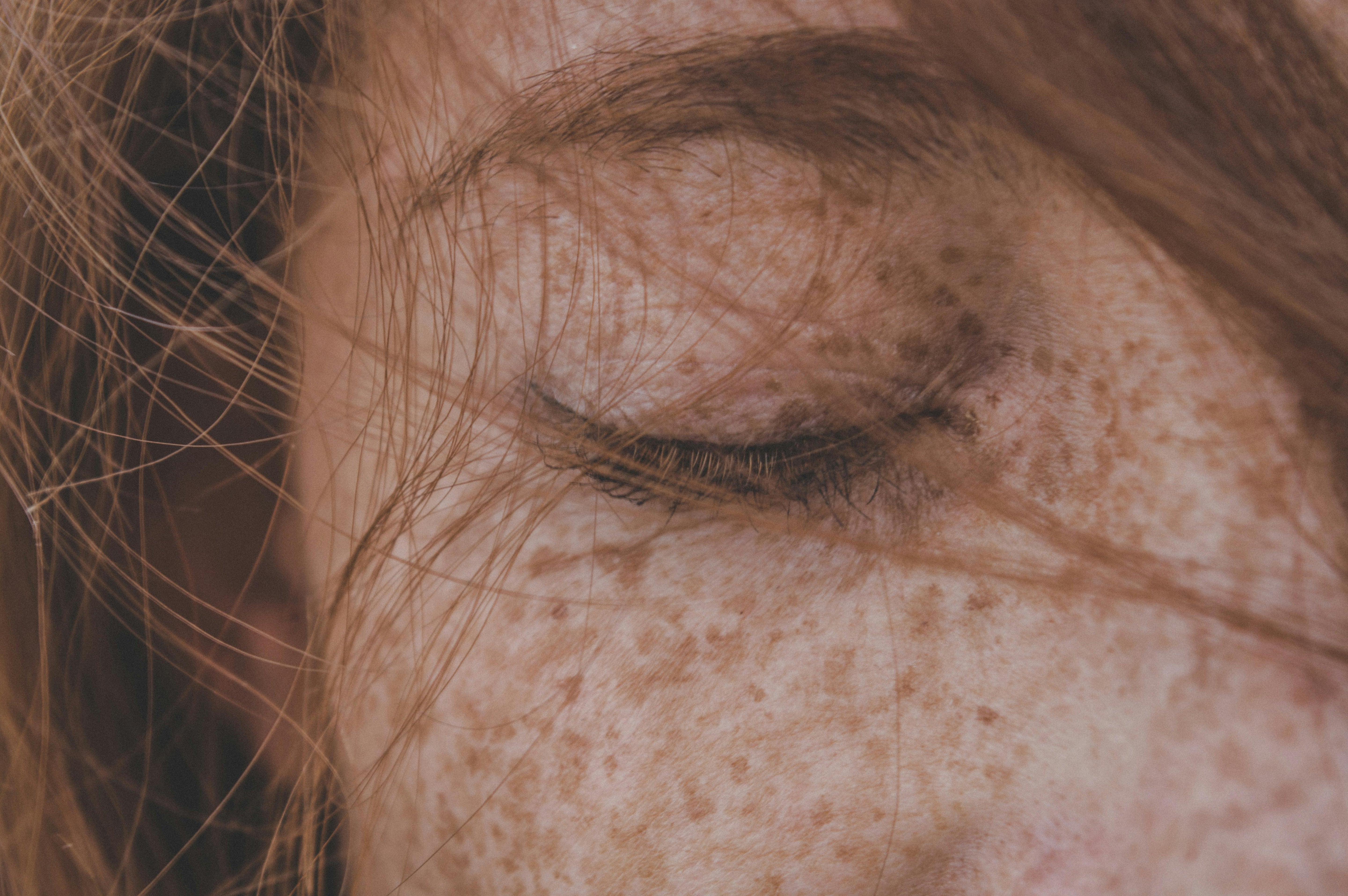 does melanotan cause freckles Types, Causes, Symptoms & Treatment How can our daughter have