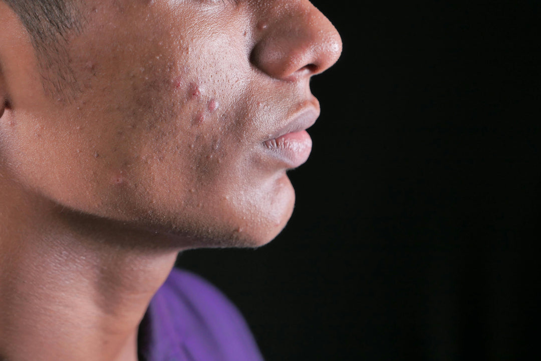 Cystic Acne: Do You Have It? How Can You Get Rid Of It Safely?