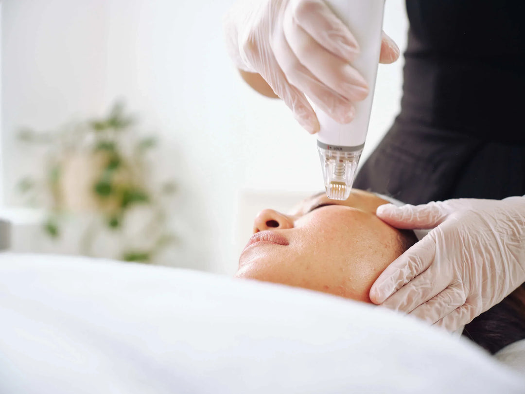 Thermage Alternatives: Comparing Skin Tightening Treatments